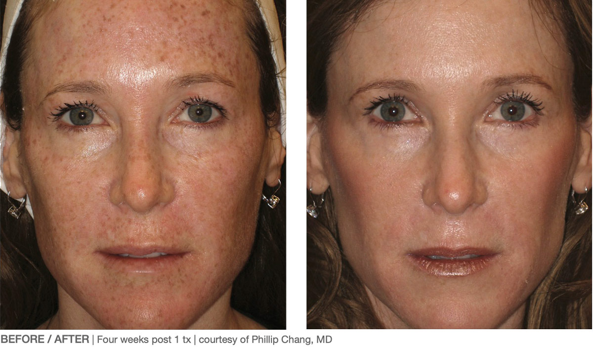 Laser Skin Rejuvenation Virginia Beach