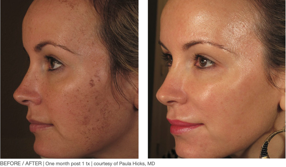 laser skin rejuvenation before after